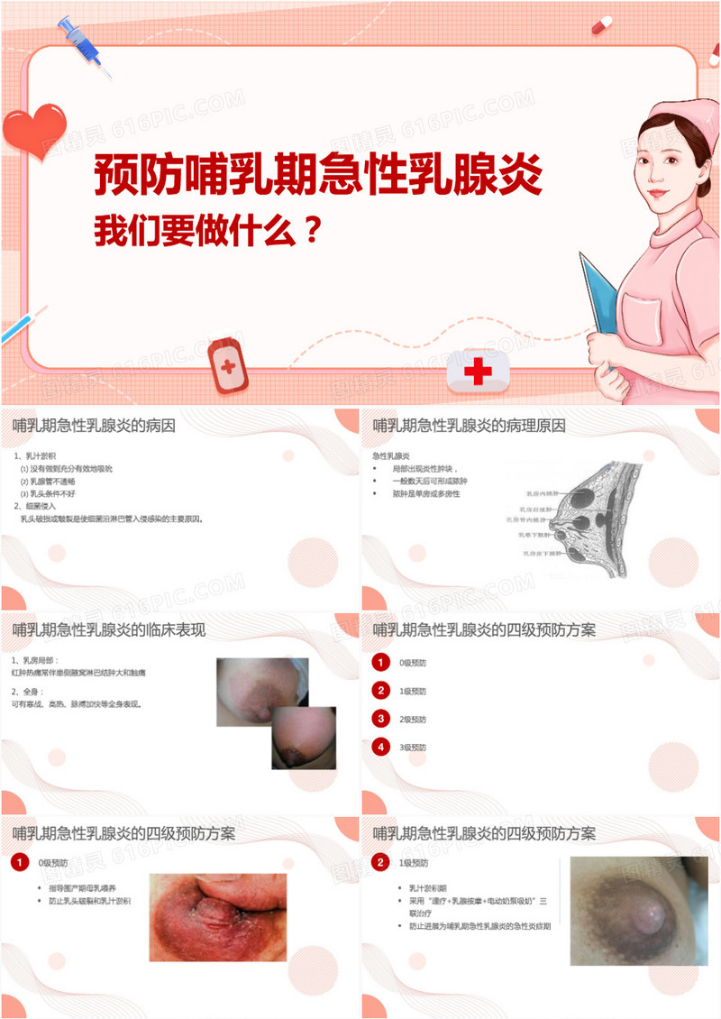 预防哺乳期急性乳腺炎措施科普PPT模板