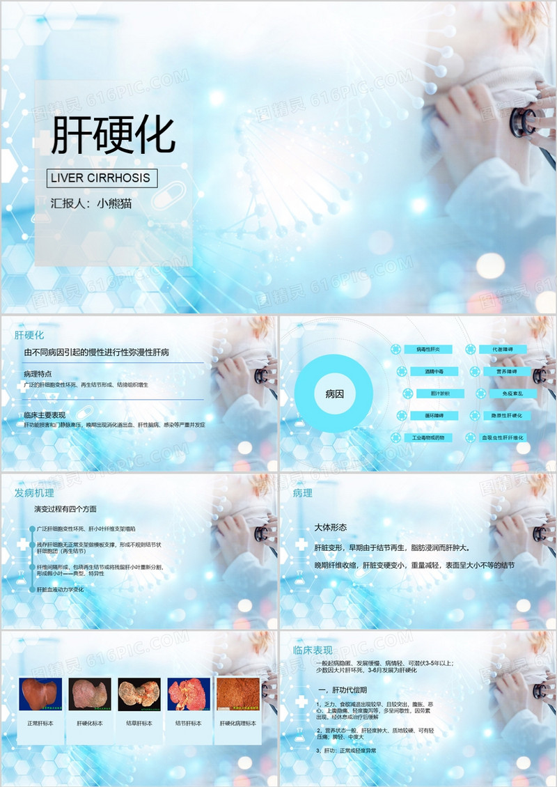 肝硬化患者护理查房肝硬化PPT模板