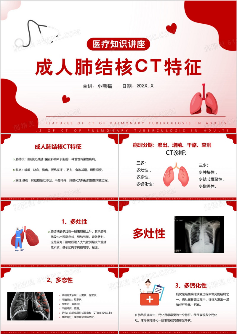 成人肺结核ct特征医疗知识讲座PPT模板