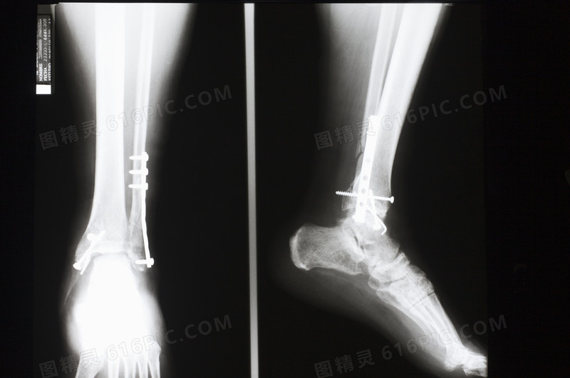 被钉钉子修复中的脚踝骨透视片