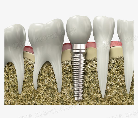 种植牙齿图片素材