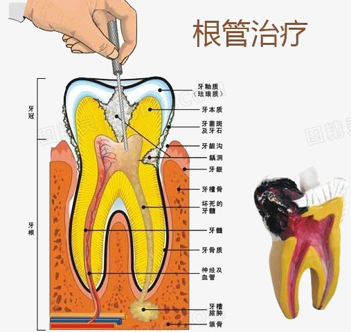 根管治疗