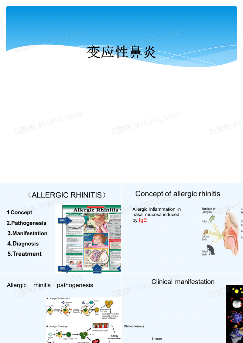 变应性鼻炎