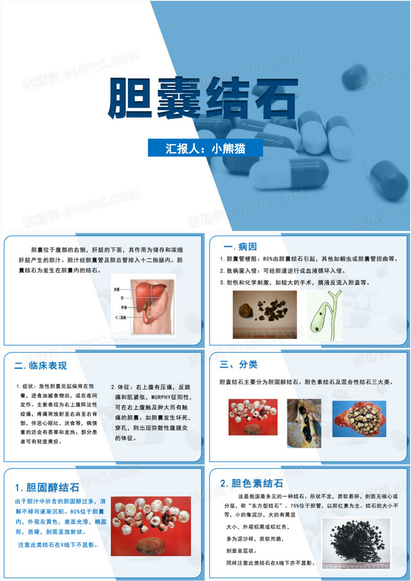 蓝色简约风胆囊结石护理查房PPT模板