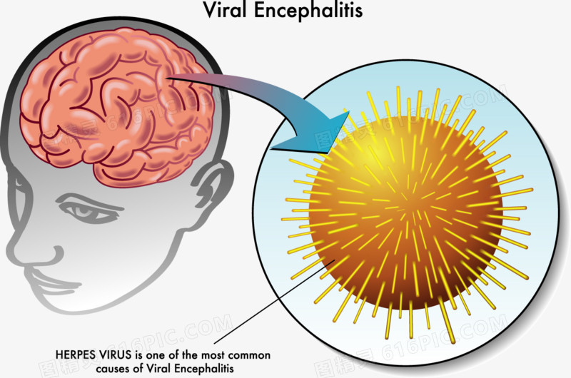 病毒性脑炎医学示意图
