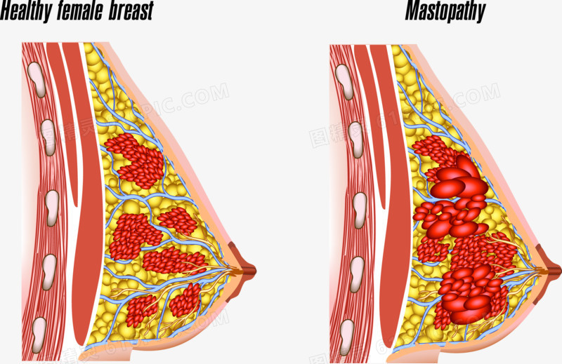 健康女性乳房和有疾病的乳房变化图